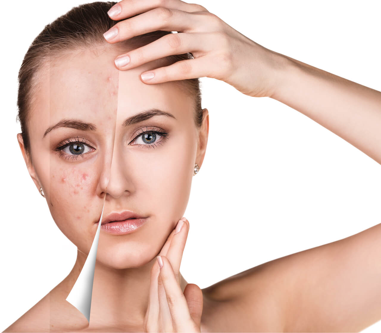 Know the best acne skin care routine - Dissolve Stress Now